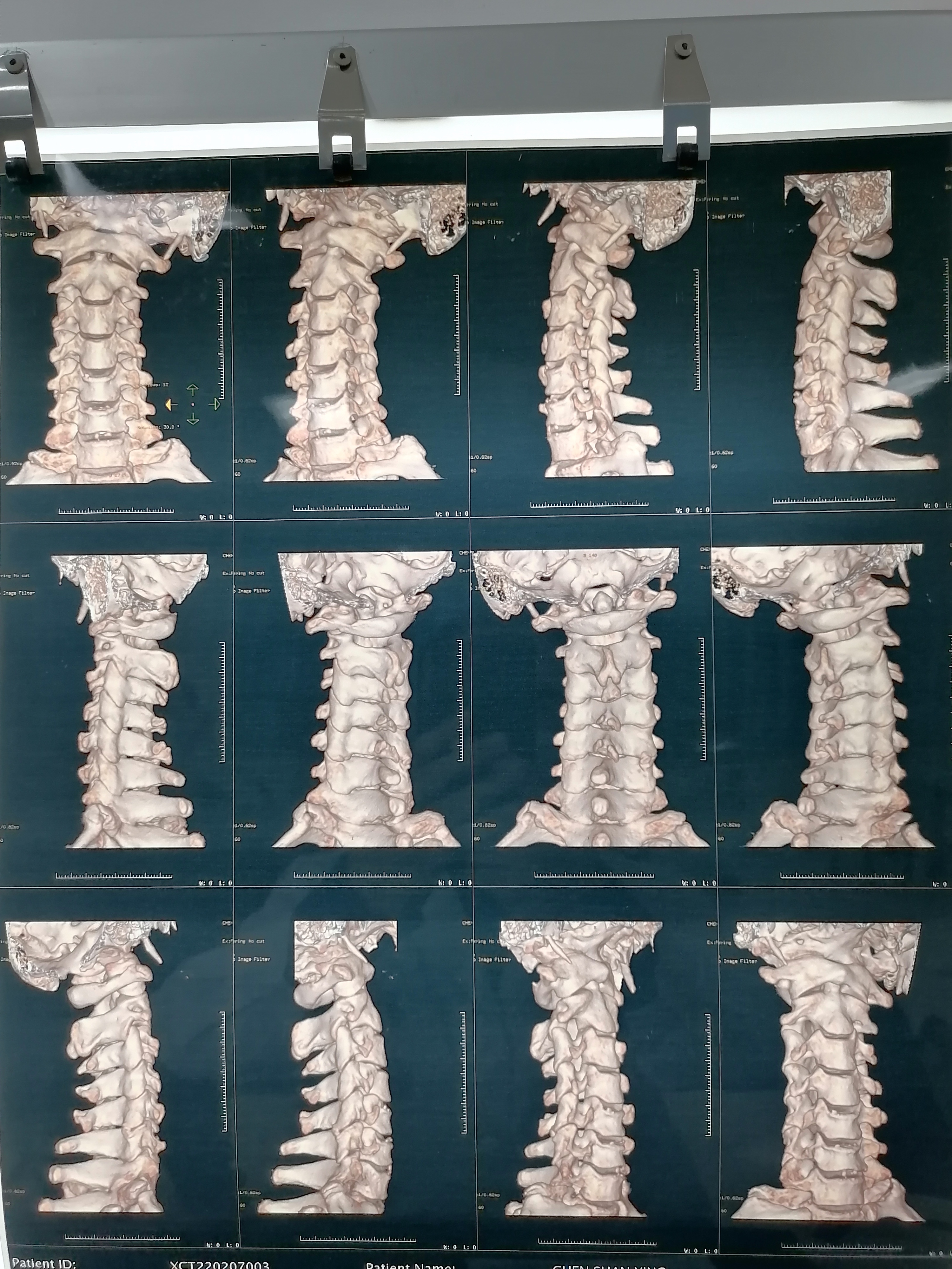 扭脖子的危害有多可怕,随便扭脖子危不危险