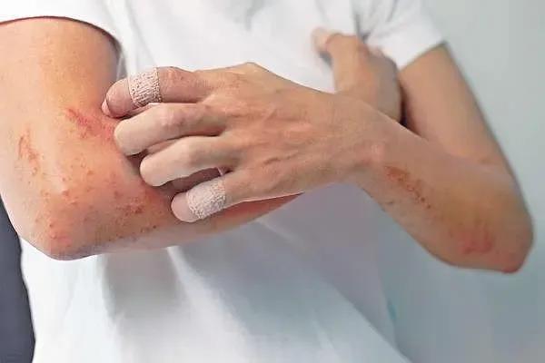 水疱型湿疹中药治疗,湿疹如何治疗发痒裂口