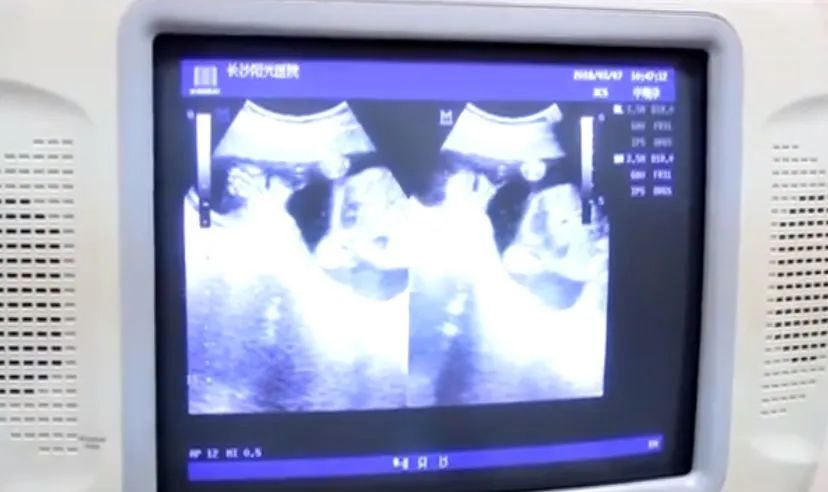 20岁卵巢早衰5年了怎么办,60多岁女性卵巢疾病都有哪些症状