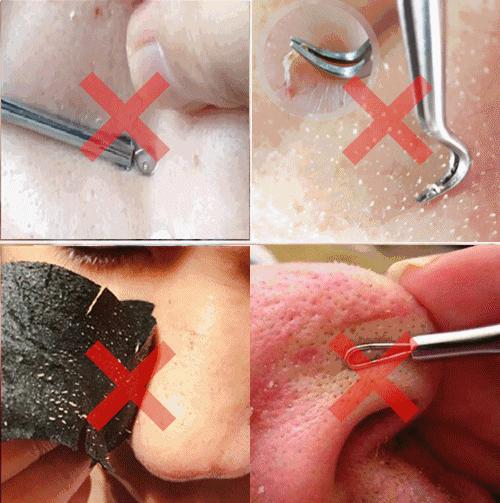 眉心鼻翼和下巴长粉刺为什么,鼻头上起粉刺什么原因引起的图片