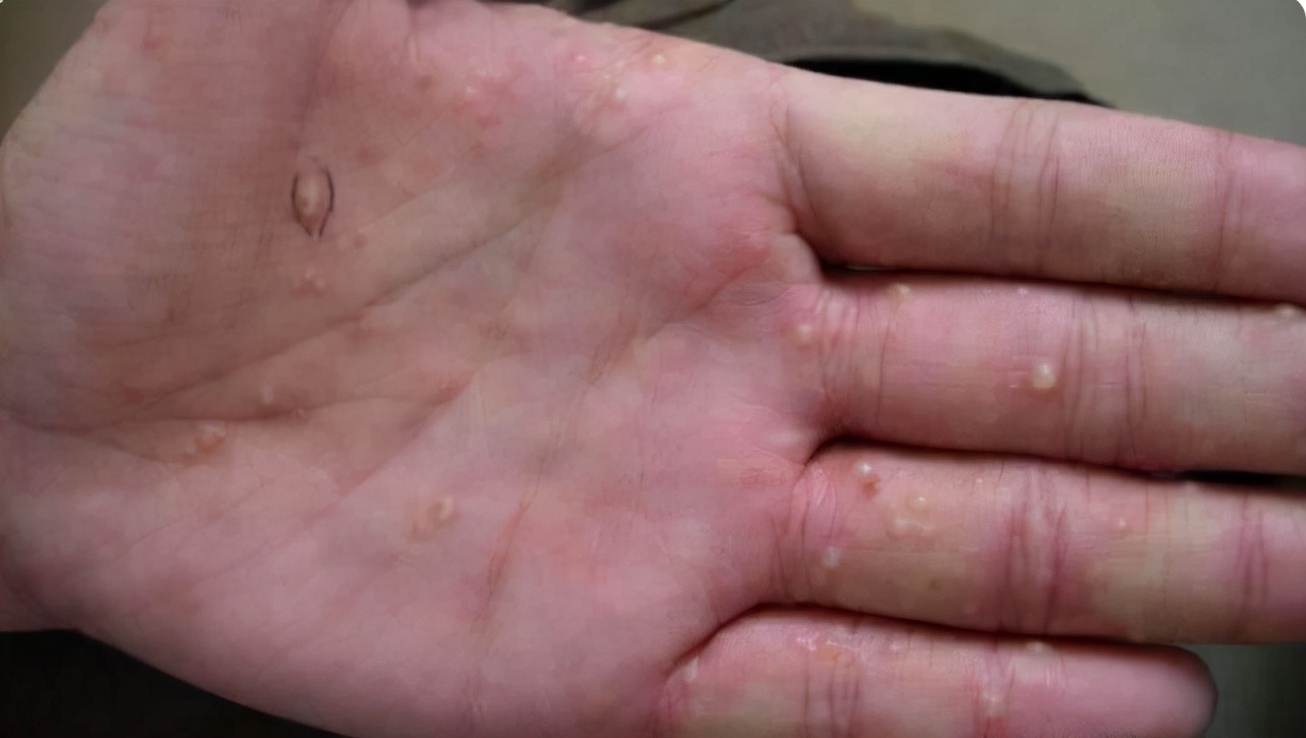 手上的水泡是脚气还是汗疱疹,手上起小水泡很痒怎么办看什么科
