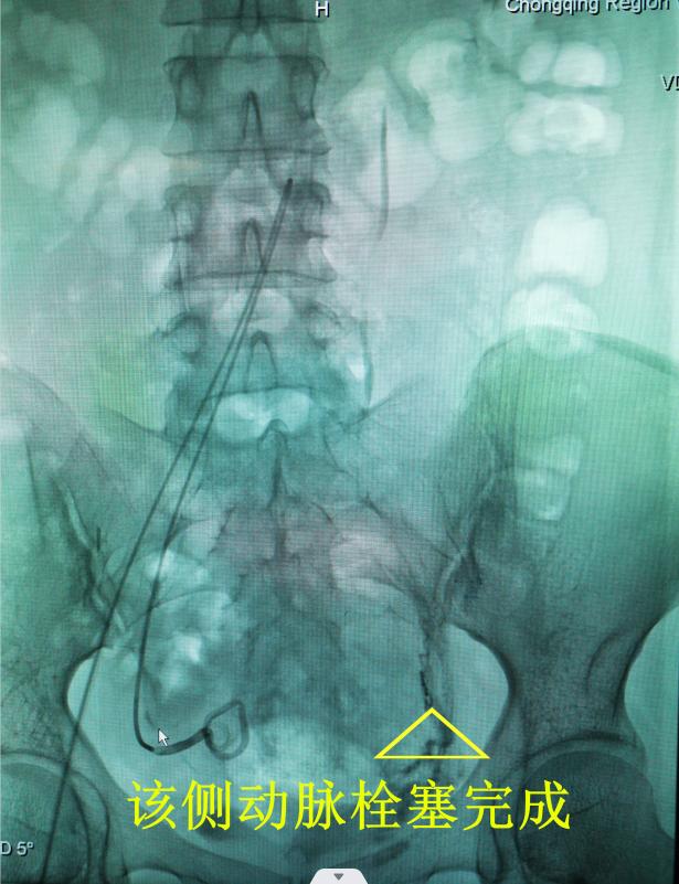 宫外孕大出血手术成功,腹腔镜下肝部分切除术大出血