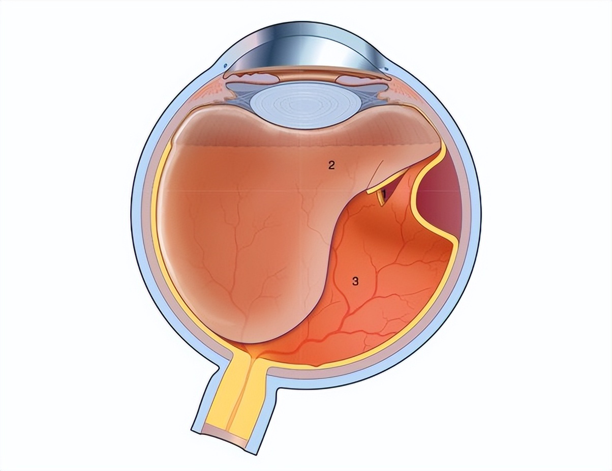 眼睛看见漂浮的小虫怎么回事,有时候眼睛看到漂浮的小虫子