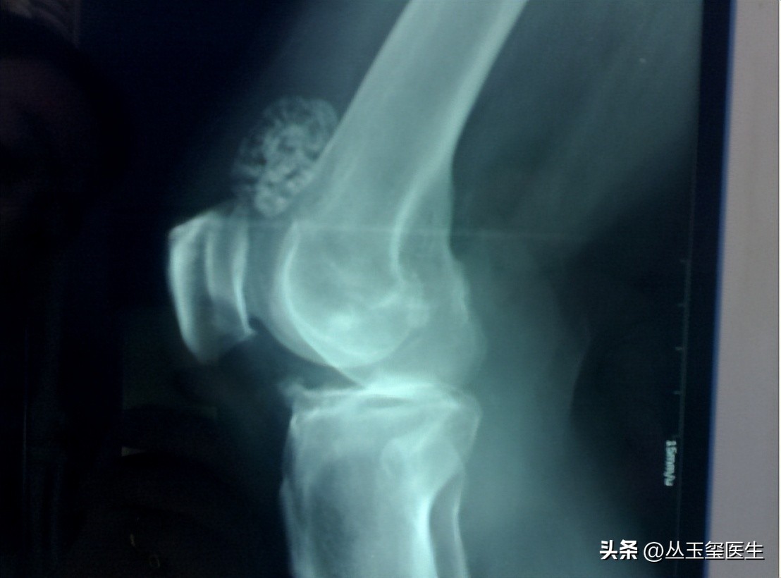 软骨瘤的前兆是什么,背上有软骨瘤该怎么治