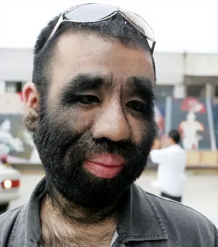 当年轰动一时的“毛孩”：42岁娶90后娇妻，生下一子未遗传长毛