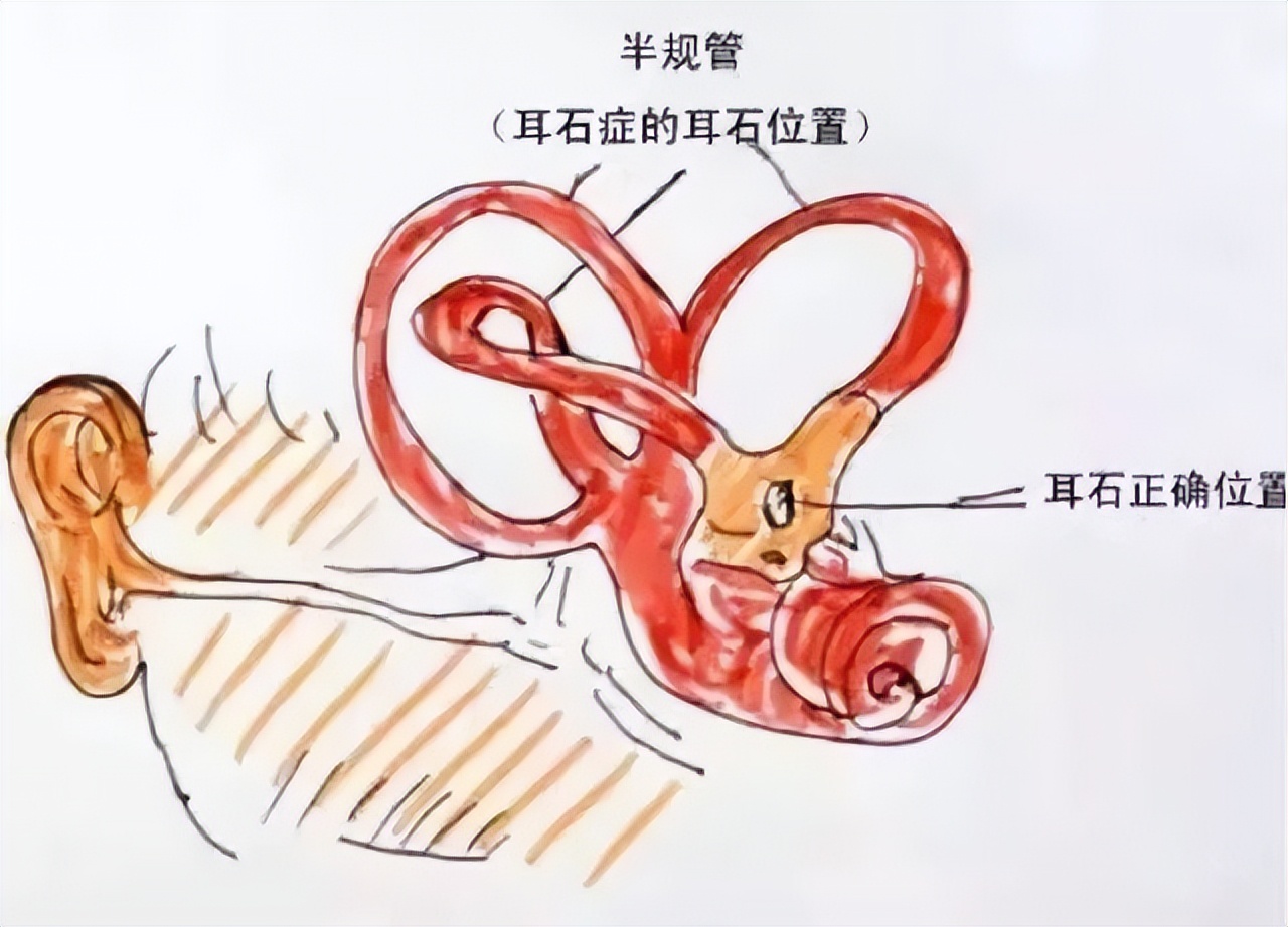 眩晕手法复位步骤,慢性眩晕的最佳治疗方法