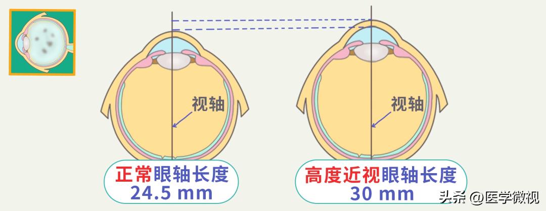 总感觉眼前有虫子在飞什么原因,老是觉得眼前有小飞虫在飞