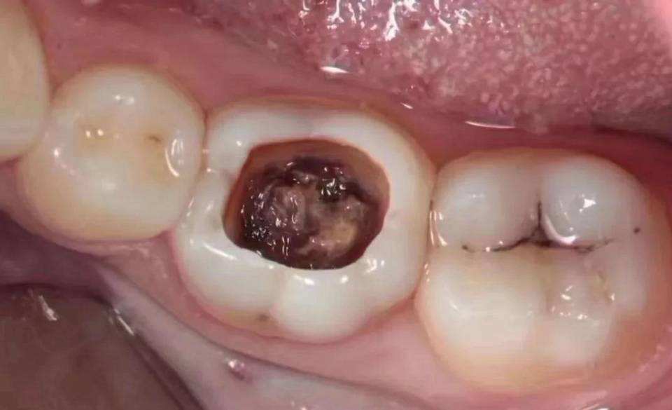 烂牙做根管治疗,烂牙做牙套好吗