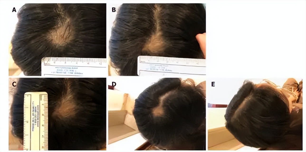 秃头康复,秃头可通过头疗生发吗