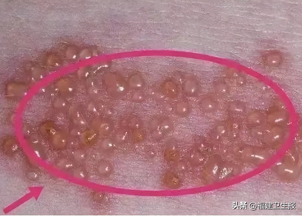 阳了后浑身痒、起疹子？医生提醒：分清类型再治疗