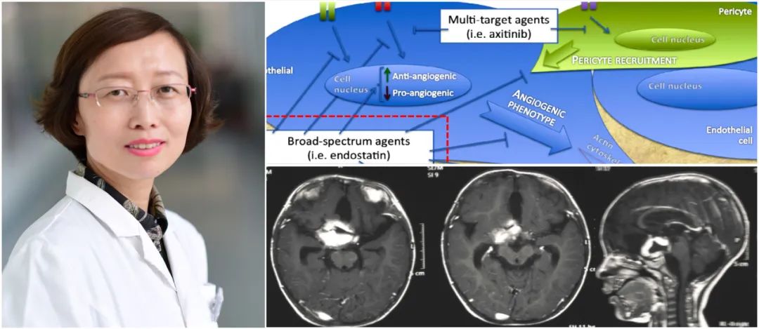 儿童型低级别胶质瘤,儿童低级别胶质瘤能治愈吗