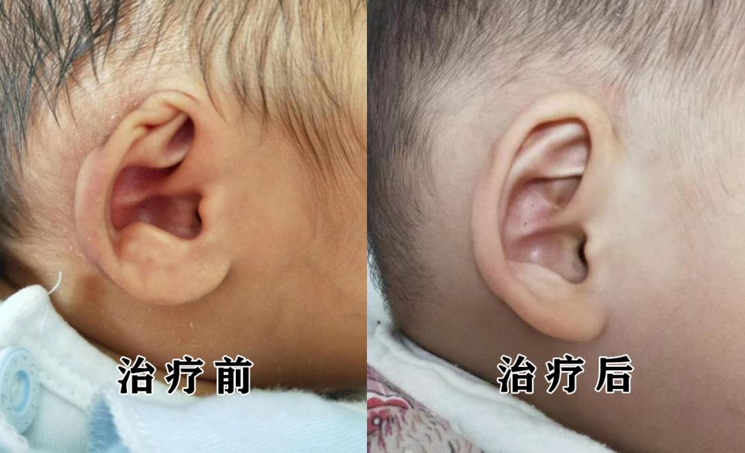 耳朵畸形是什么原因引起的,小孩出生一只耳朵畸形