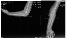 肱骨骨折取钢板怎样恢复,肱骨近端骨折切开复位内固定术