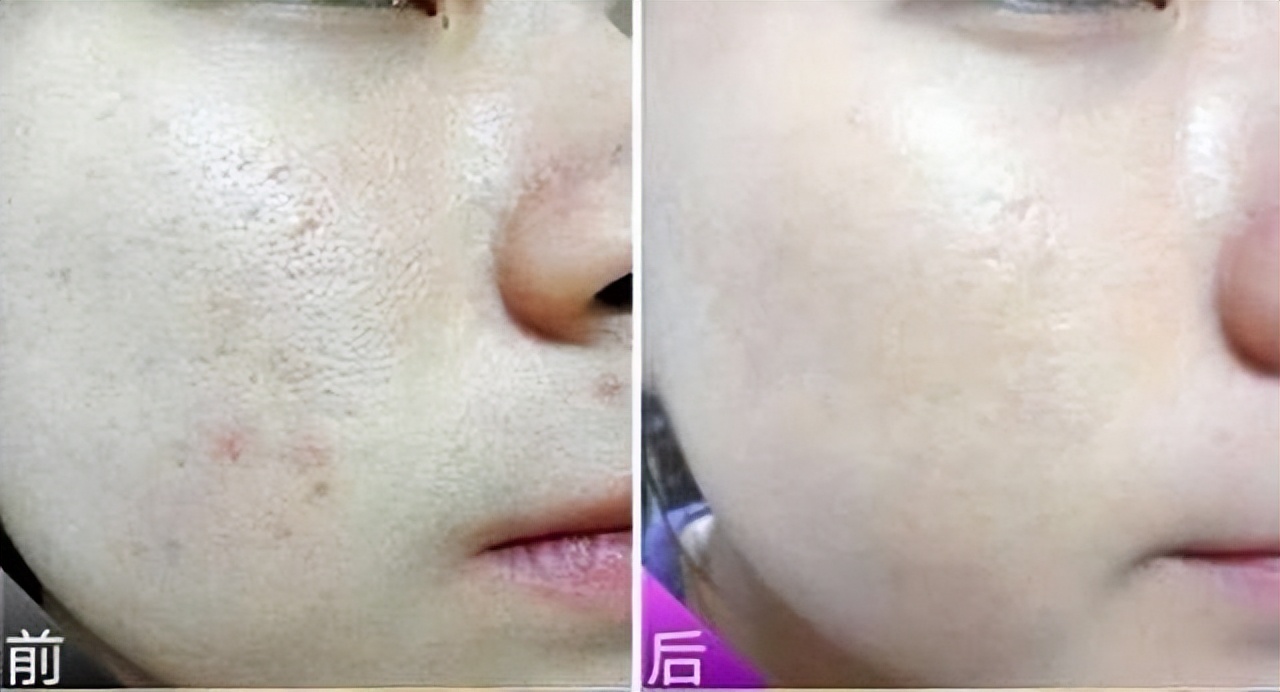 m22光子嫩肤仪器治疗雀斑副作用,光子嫩肤可以祛痘印吗有副作用吗