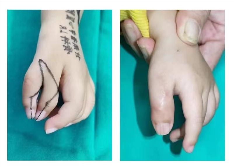 骨科医生手畸形,先天性手关节畸形弯曲