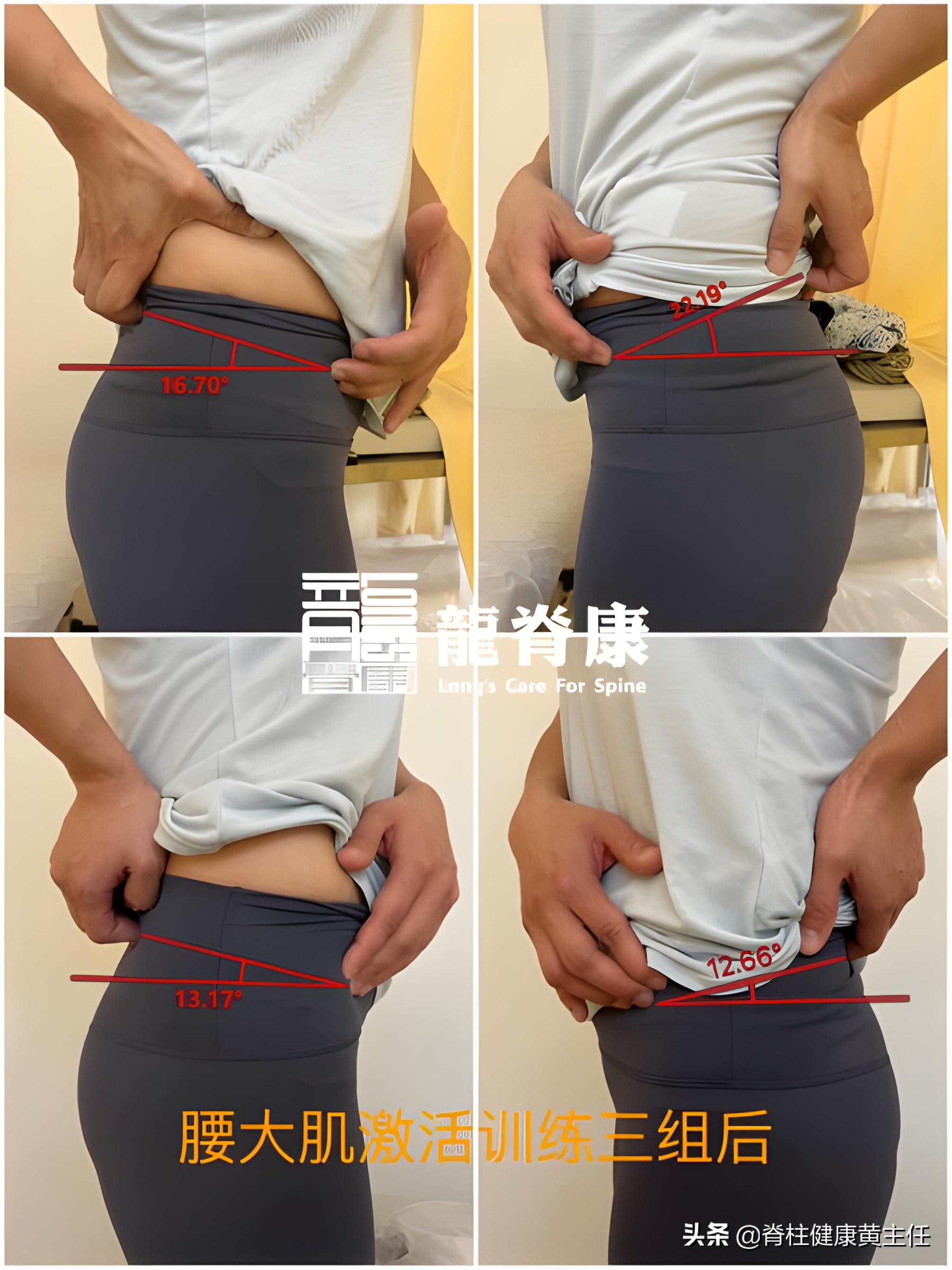 小腹突出骨盆前倾怎么纠正,怀疑骨盆前倾需要去医院治疗吗