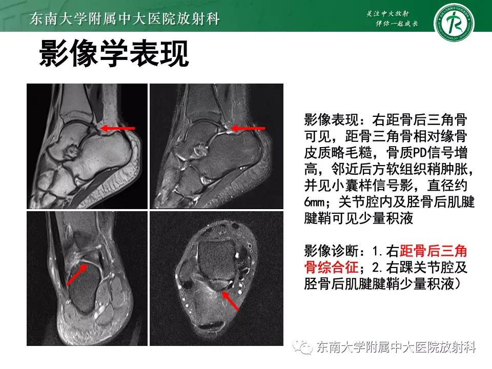 好文分享-《肌骨系统疾病——副舟骨综合征》
