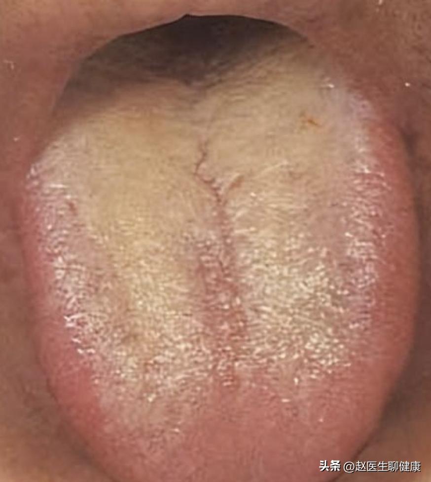 寒湿大便不成形粘马桶吃什么调理,大便粘腻粘马桶不成形中药调理