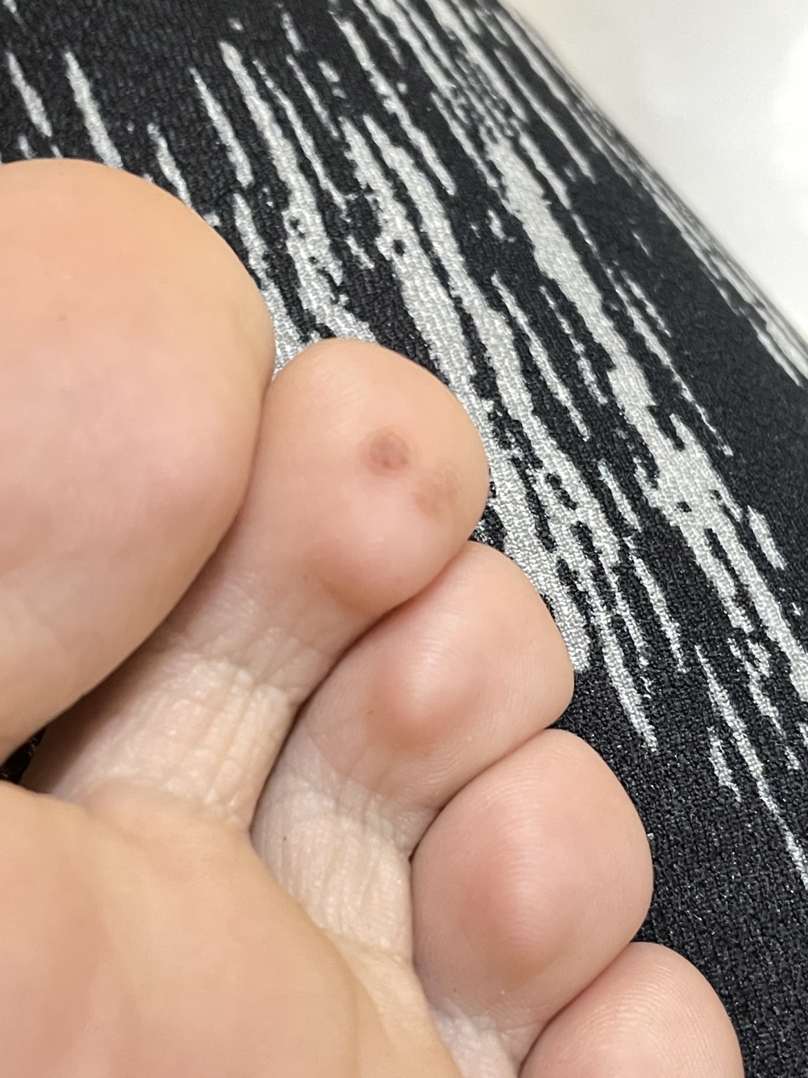 怎样辨别鸡眼和跖疣,如何辨别鸡眼和跖疣区别