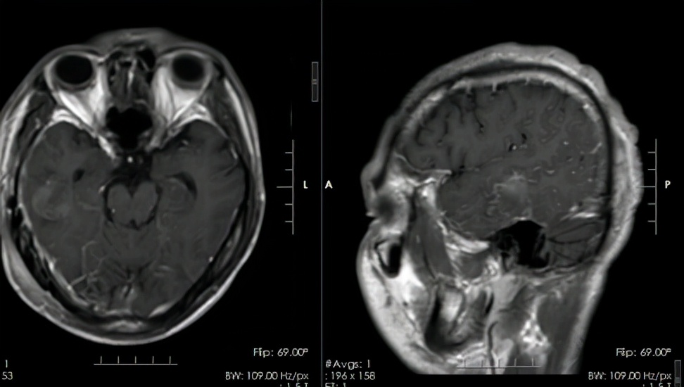 3岁男孩颅内肿瘤,33岁小伙肿瘤