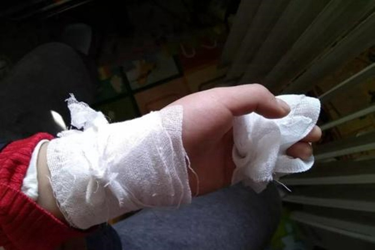 如果孩子被烫伤怎么正确处理,小孩被开水烫伤怎么处理好