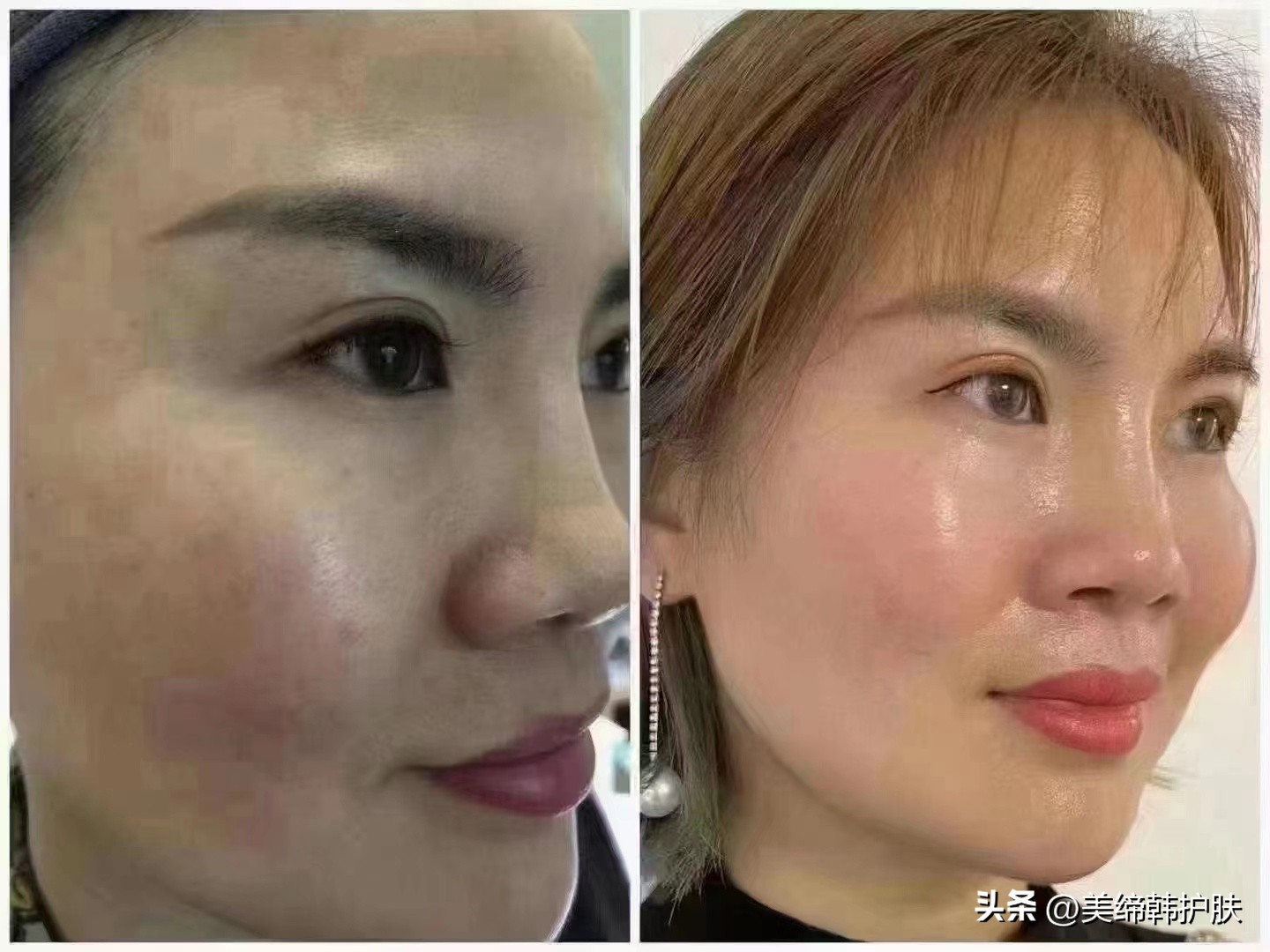 敏感肌泛红用什么护肤抗皱,如何正确认识敏感肌