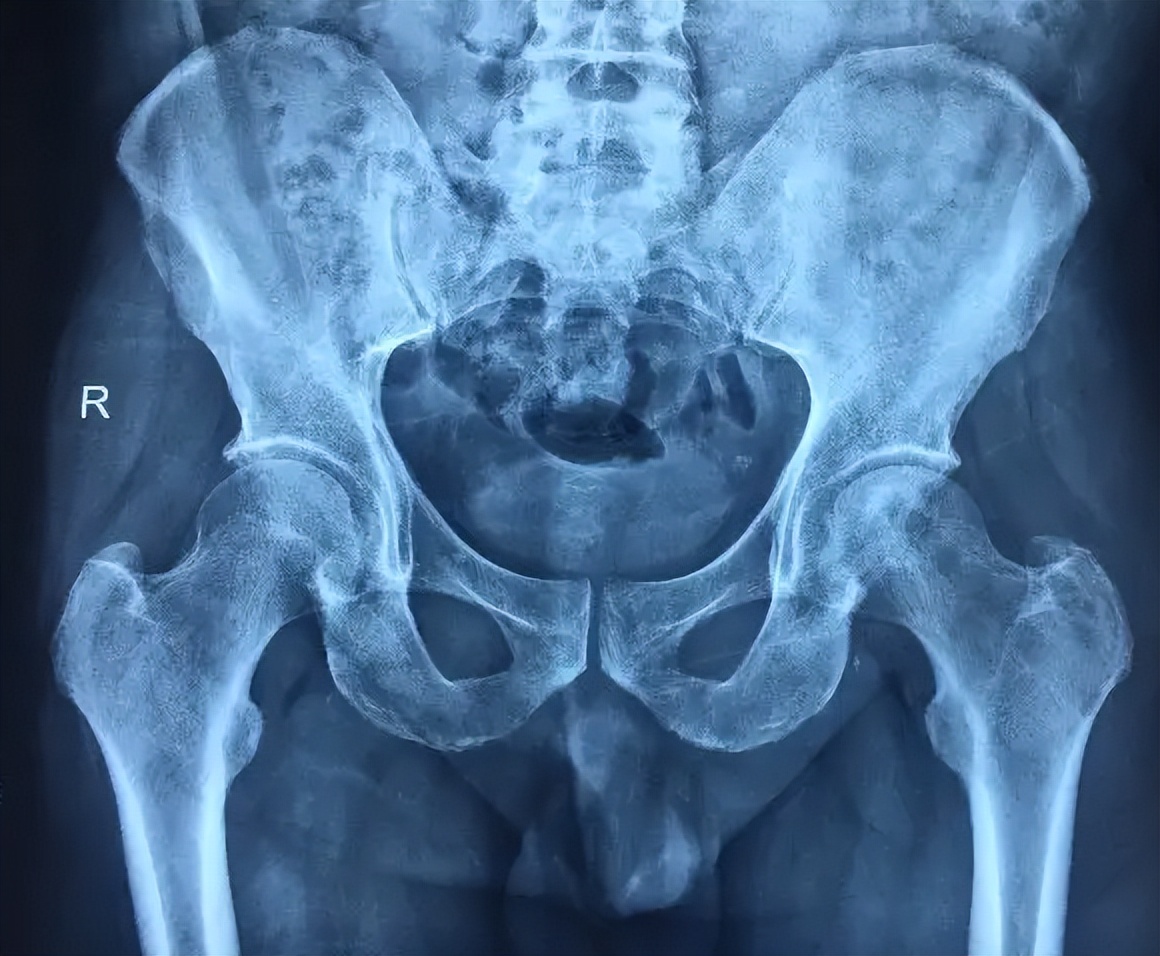 股骨头取钉后坏死有什么症状,男性患股骨头坏死的全身症状