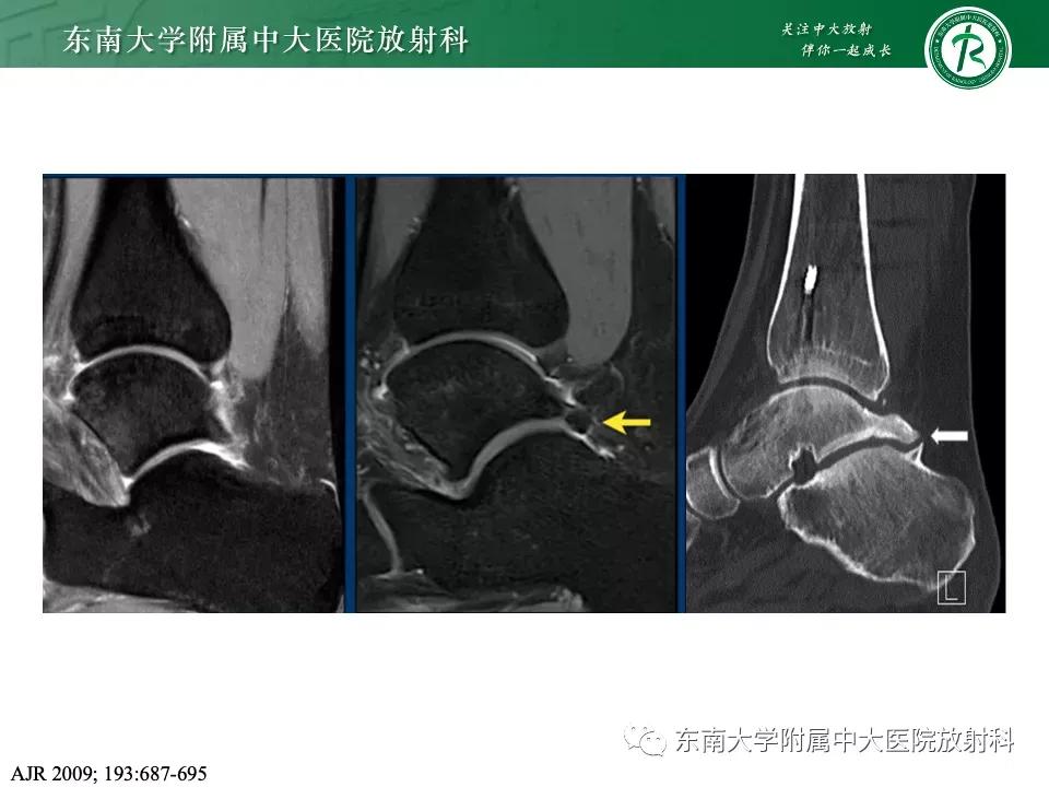 好文分享-《肌骨系统疾病——副舟骨综合征》