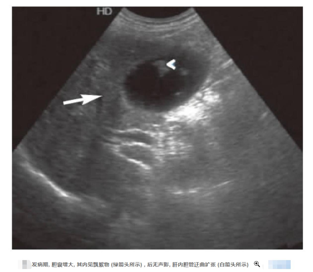 鐢峰瓙鍙嶅鍙戠儹绔熸槸鎮ｄ簡鑲濆惛铏梾,鑲濋儴鎰熸煋瀵勭敓铏槸鎬庝箞鍥炰簨