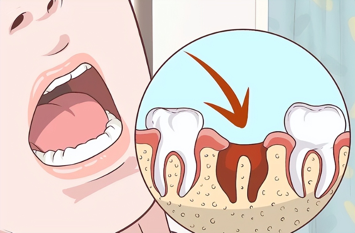 拔牙后伤口好了牙龈肿痛,拔牙后牙龈如何快速消肿