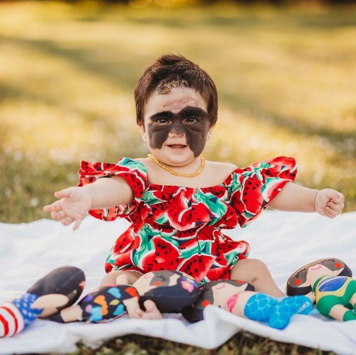 美国小女孩脸带“蝙蝠侠”黑印,治疗两年经过终于恢复肉色!