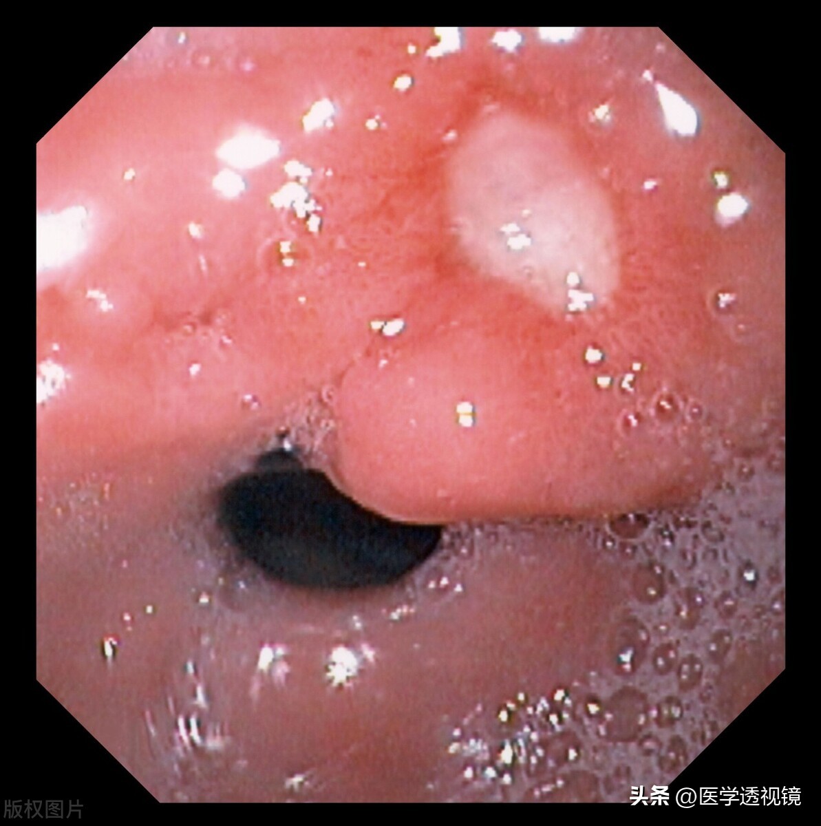 装了心脏支架小便有血是怎么回事,做心脏支架后消化道出血