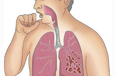 喉咙总感觉有痰又咳不出来怎么办,痰吐不出来咽下去有什么危害