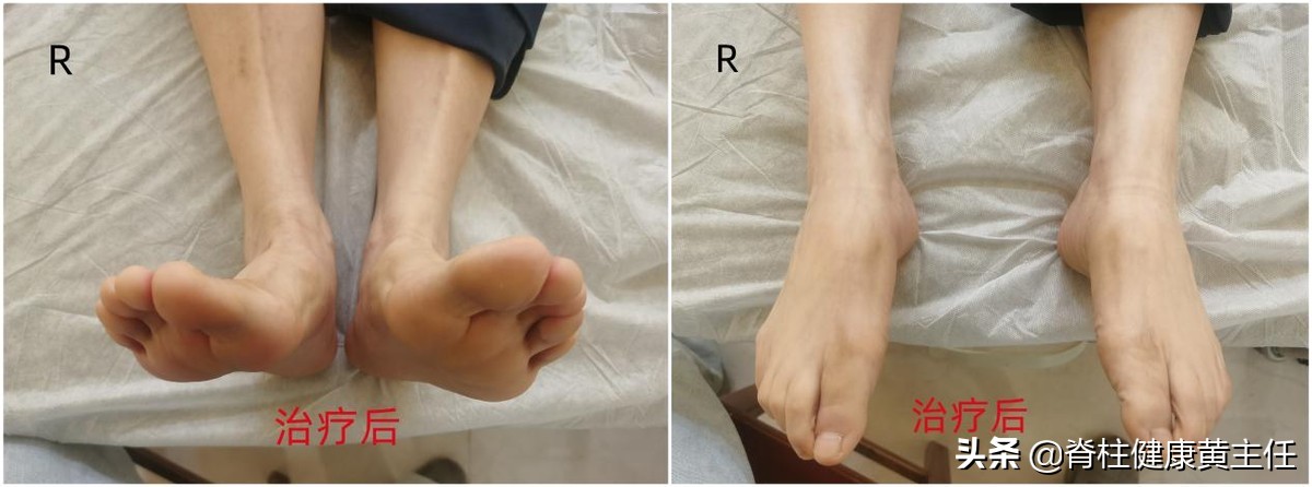踝关节损伤疼痛一招搞定,踝关节受损的康复治疗方法