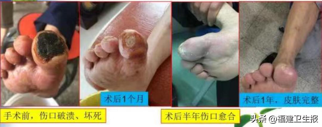 下肢闭塞脚趾变黑一定要截肢吗,脚趾头发黑截肢