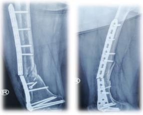 更好服务患者西安市红会医院骨不连专科门诊开诊