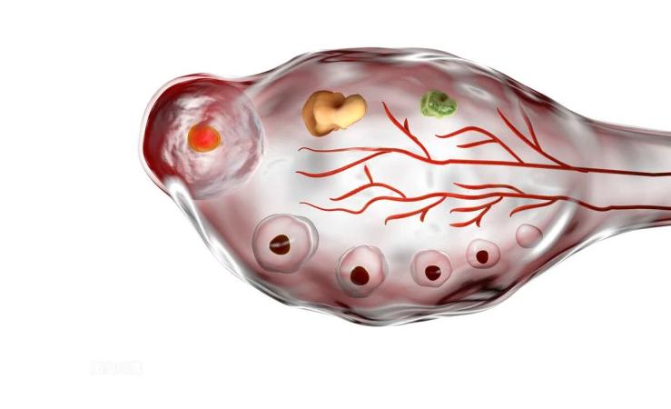 女人为什么反复长子宫肌瘤,如何防止长子宫肌瘤