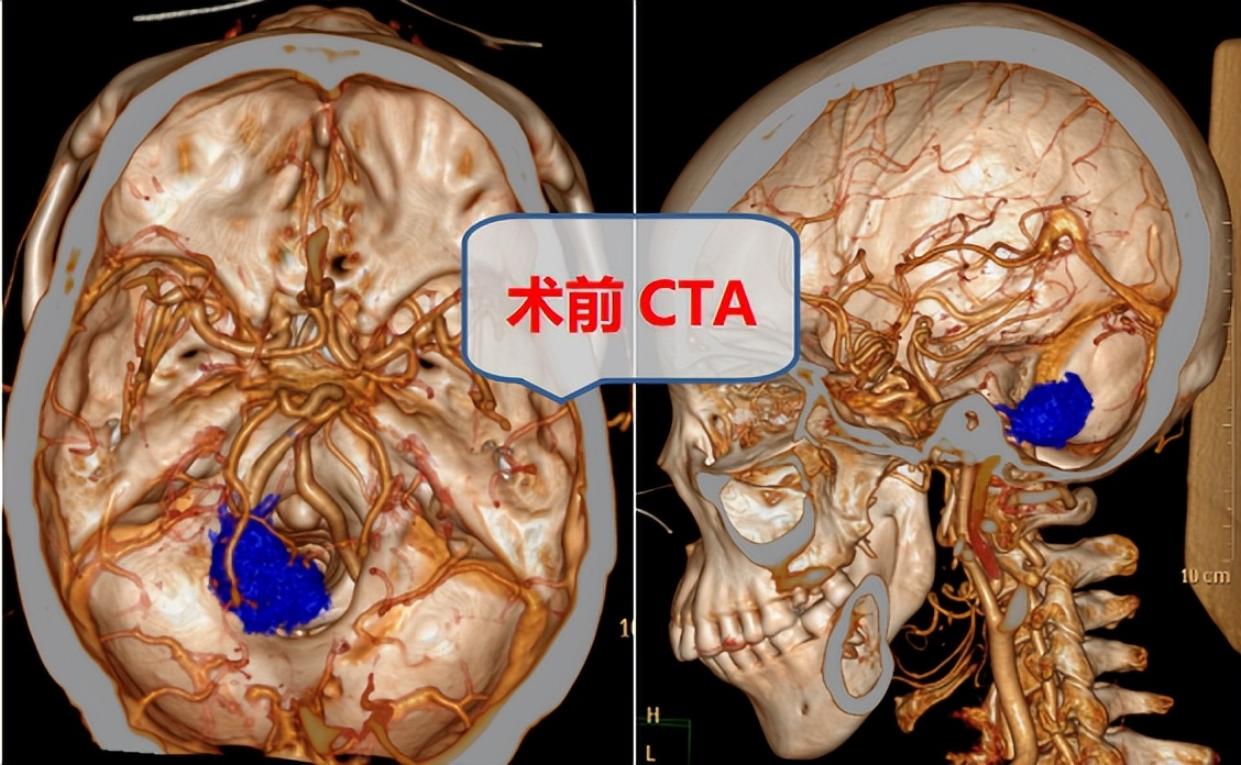 脑梗走路总想往一侧歪,走路总往右侧歪是怎么回事