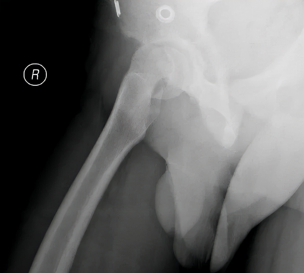 小儿骨科科普类短视频,股骨头骨骺滑脱中医手法治疗