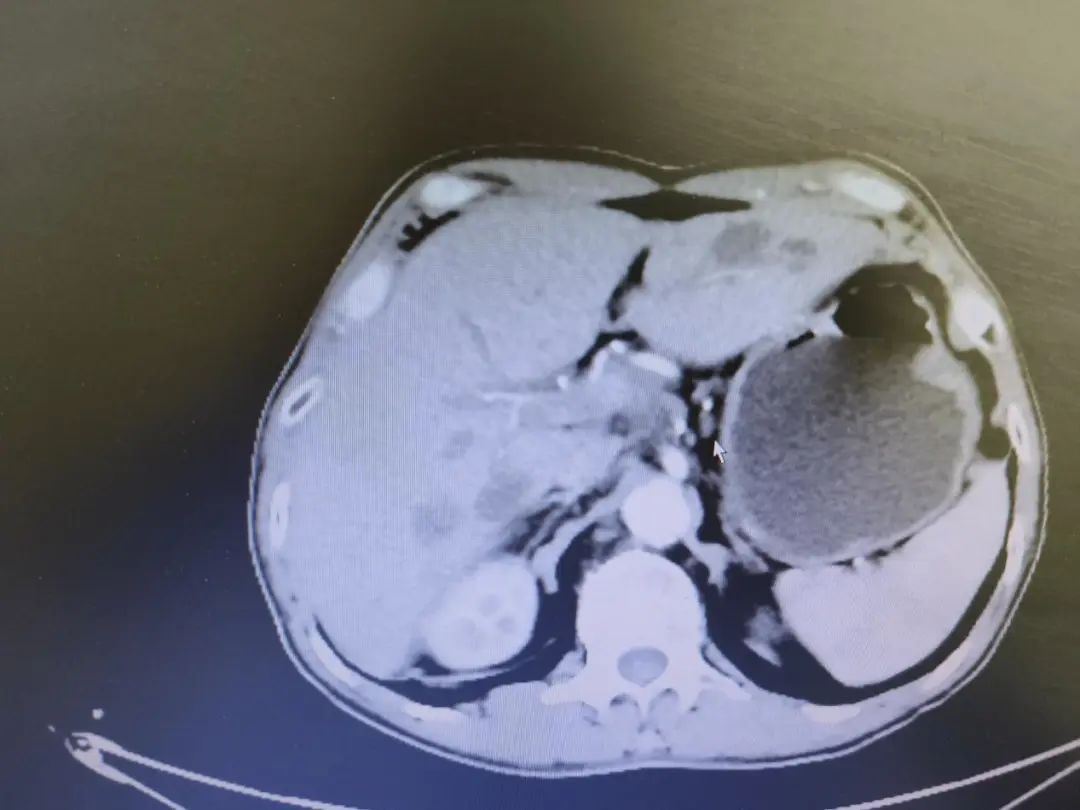 胃癌晚期化疗的全过程视频,化疗过程视频完整版胃癌