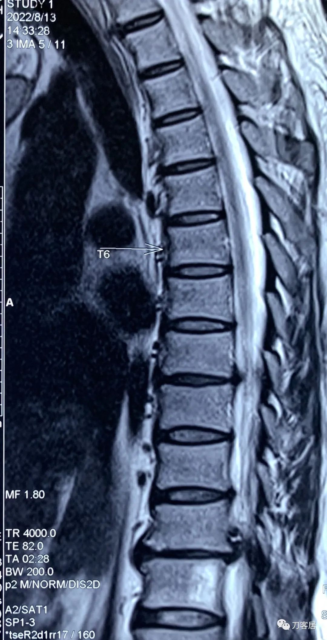 良性单侧下肢肌萎缩,下肢肌肉萎缩24年能治好吗