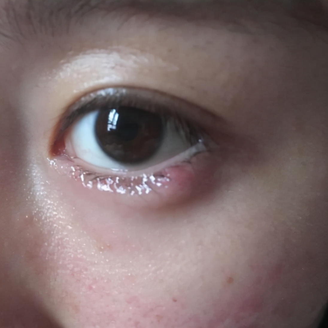 几块钱一支的红霉素眼膏，到底能治多少病？答案来了