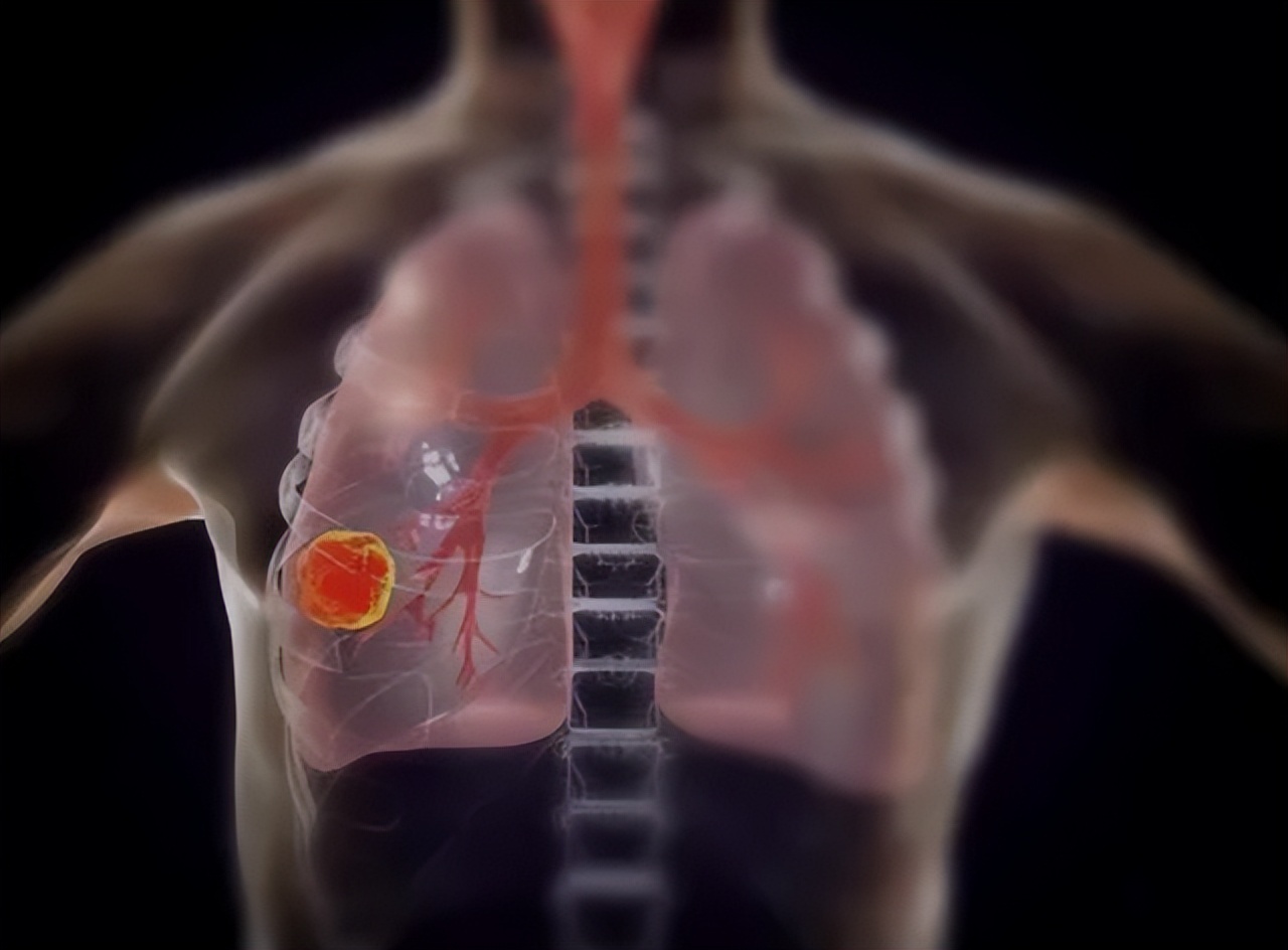 肺癌晚期加尿毒症晚期能活多久,肺癌晚期的症状一般还能活多久