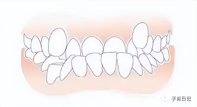 牙齿治疗算一般疾病么,牙齿烂个洞不能拖