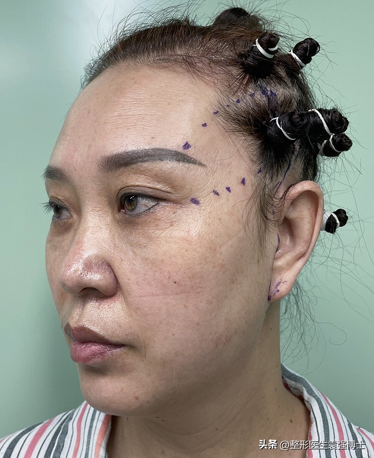 拉皮手术后7天效果图,拉皮手术术后恢复注意事项