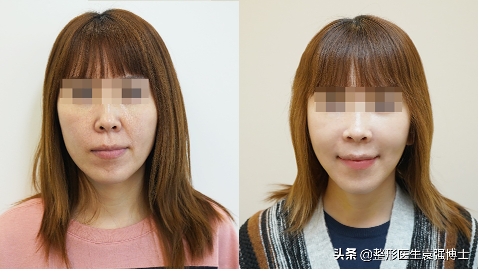 拉皮后10年后的后遗症的真实案例,拉皮手术后遗症出现在什么时期