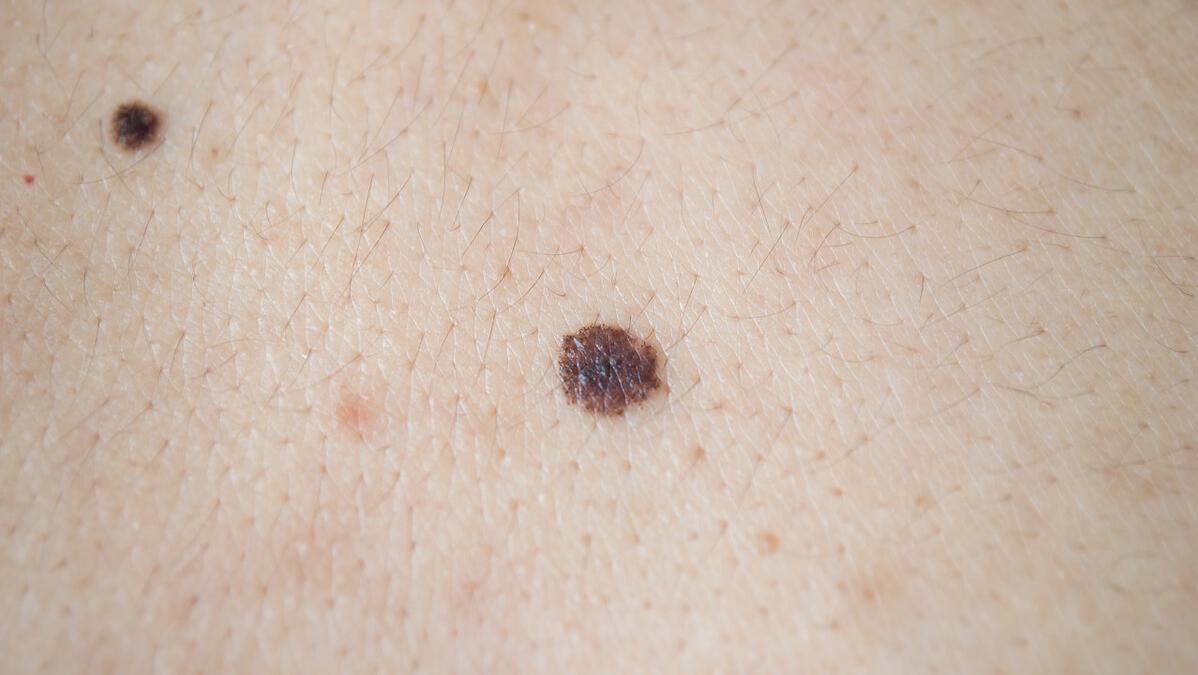 痣越长越大就是癌症的可能吗,长在4个部位的痣与癌症息息相关