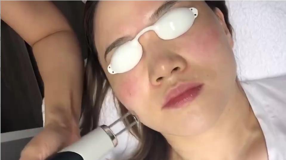 光子嫩肤怎么拍照,光子嫩肤做完后的效果图