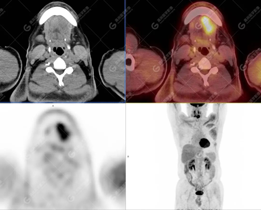 肺部结节确诊是癌如何治疗,肺结节疑似早期恶性肿瘤