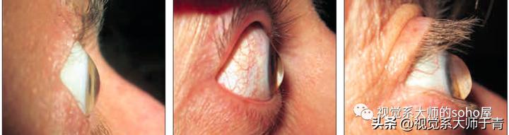 巩膜镜的验配技巧及案例分享,试戴巩膜镜成功率高不高